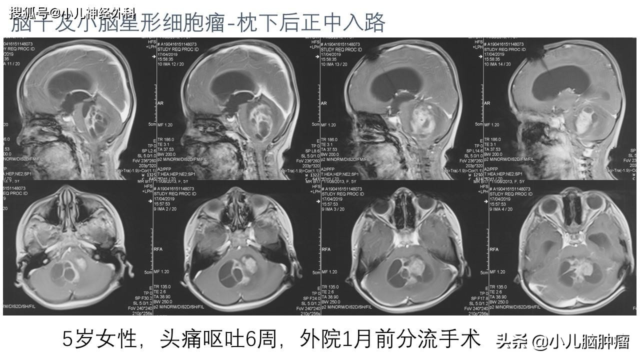 脑肿瘤后做脑积水引流会扩散吗,脑积水分流管是在颅内还是颅外