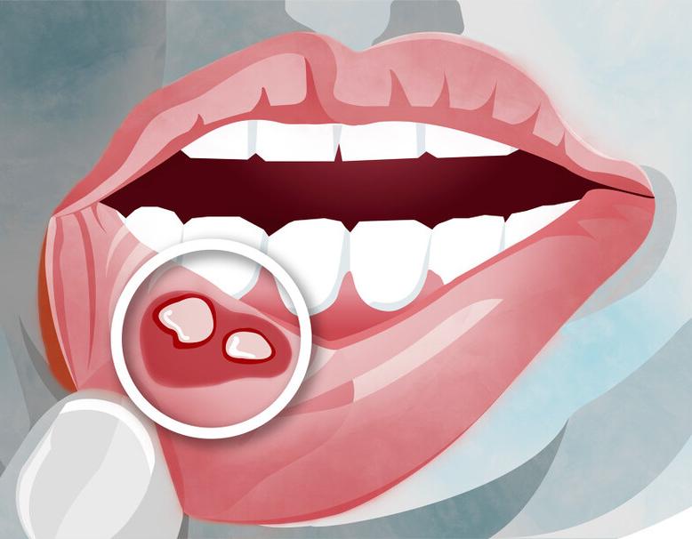 为什么西瓜霜等药对口腔溃疡没用,哪种西瓜霜对口腔溃疡最有用