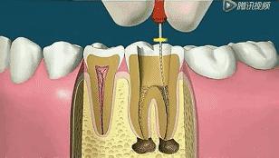 澳洲牙膏排行榜前十名,根管治疗的牙膏有哪些