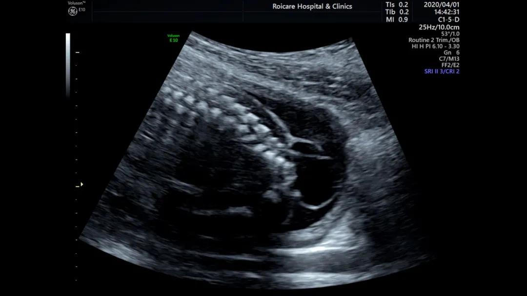 胎儿期发现脊髓圆锥位置低的临床指导