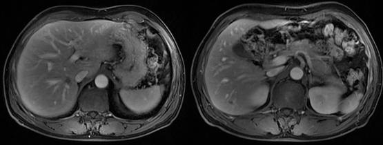 放疗局控百分百：鼻咽癌肝转移化疗联合免疫治疗失败后