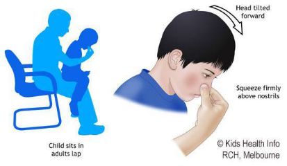 白茅根治疗鼻出血,激光治疗鼻出血后