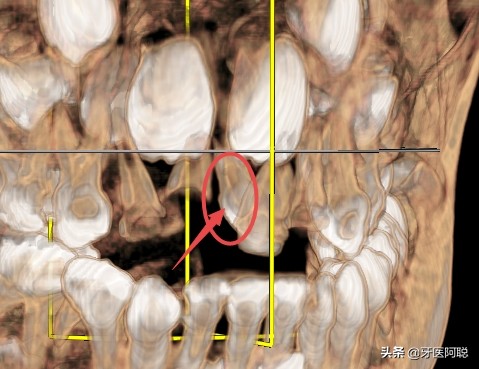 儿童多生牙全景图片，什么时候拔除比较合适