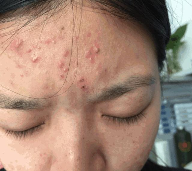 长黑头VS不长黑头差距这么大?精致女孩如何绕过黑头这道坎?