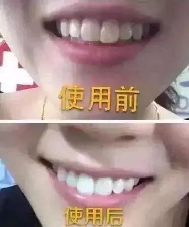 冷光美白有一次就能搞定的吗,冷光美白过程