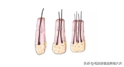 毛囊脱发怎么治疗最有效,治疗脱发有什么办法吗