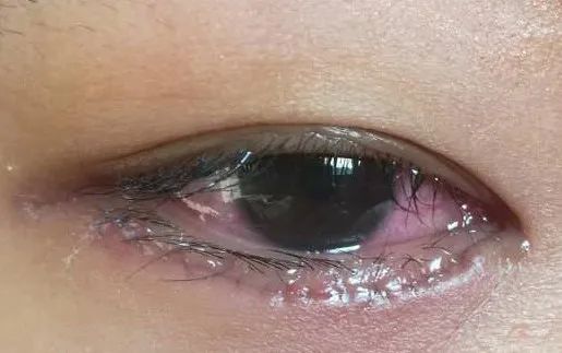 眼整形修复权威科普,科普眼整形手术是个什么手术多图