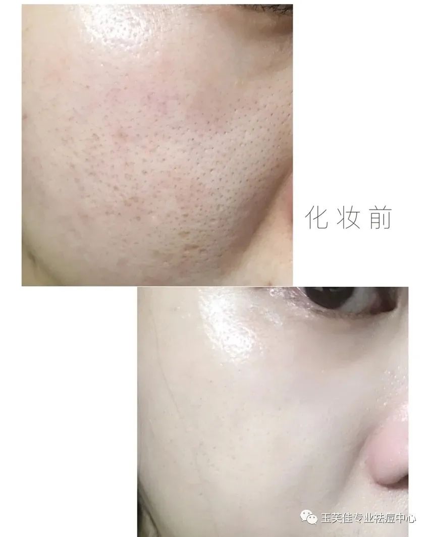 痘痘肌化妆教程用什么颜色遮瑕,痘痘肌化妆教程初学者淡妆