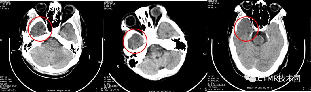 CT影像技术,脑部做ct有伪影是怎么回事