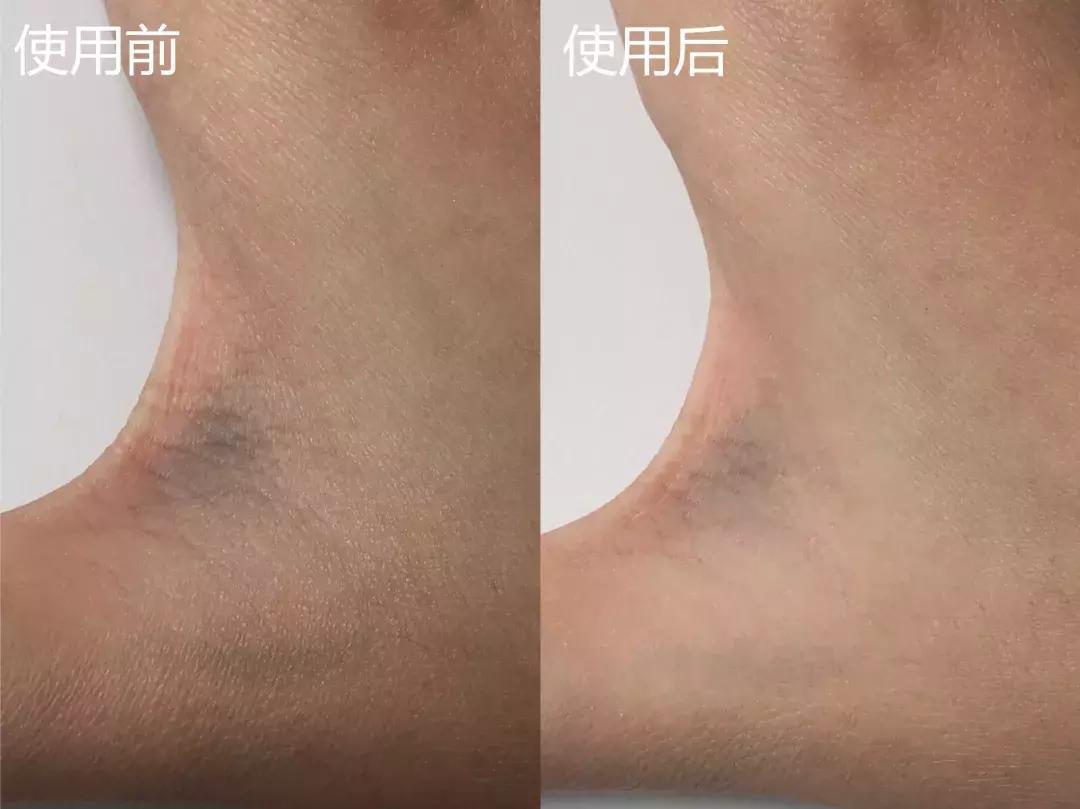 护肤黑科技顶级医美,用黑科技去除眼袋肿了十天