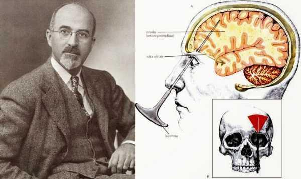 大脑前叶切除术治疗精神病,精神病恐怖案例