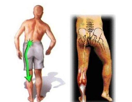 腰椎间盘突出严重程度划分标准,老人腰椎间盘突出压迫神经腿疼