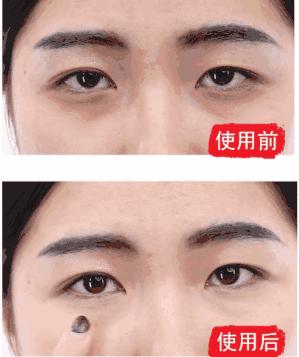眼袋越来越严重怎么救,有眼袋显老十岁一招教你消除