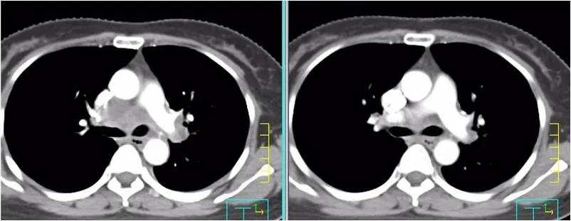 免疫疗法治鳞癌是可单独实施吗,肺转移性鳞癌免疫组化