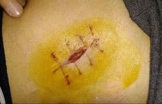 脂肪液化伤口不愈合需要注意什么,伤口液化不愈合会一直液化吗