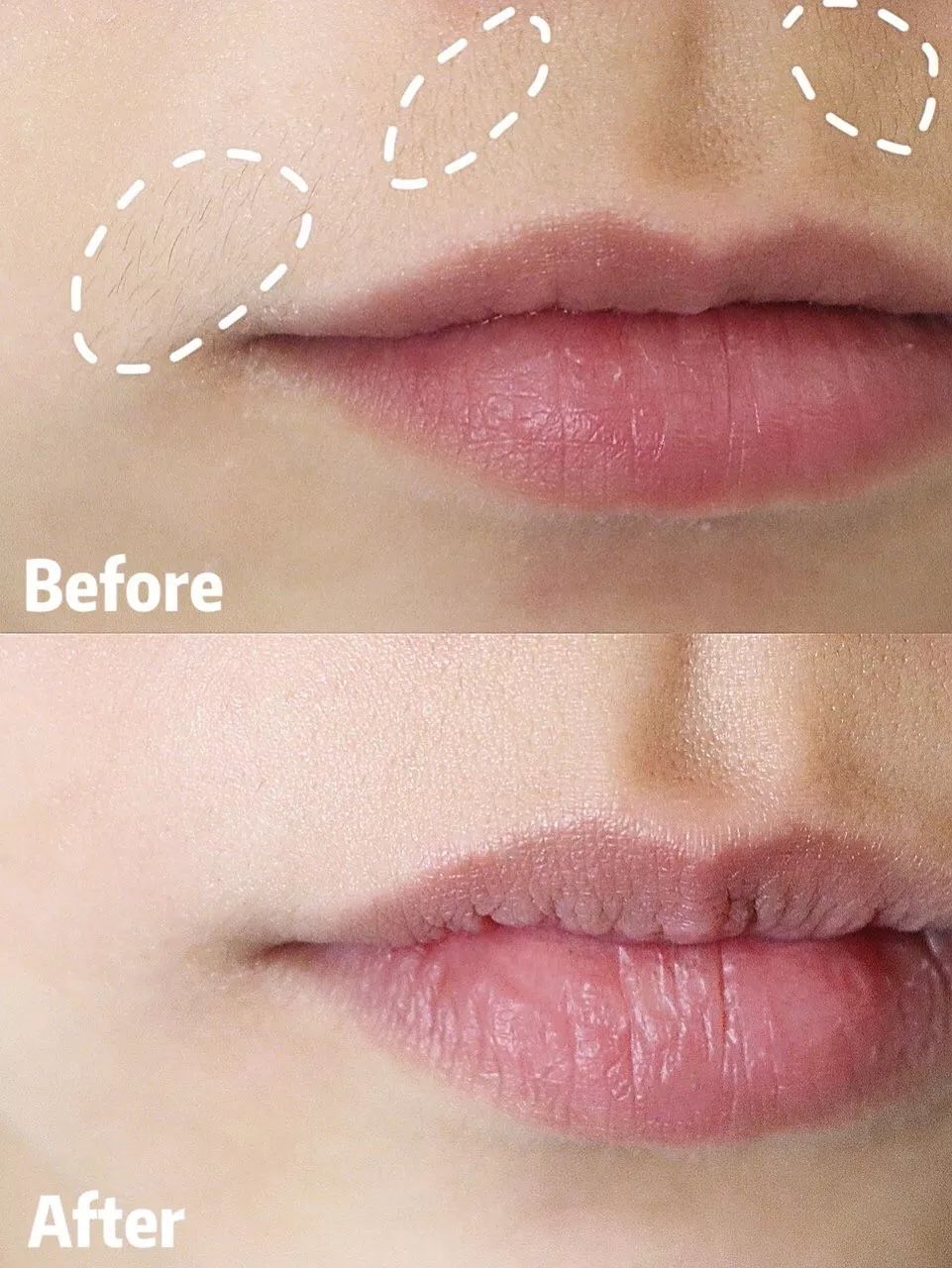 脱毛方法排行榜第一名,目前最好的脱毛技术