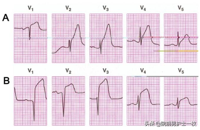 急性心梗的紧急处理视频,一旦发现急性心梗如何救
