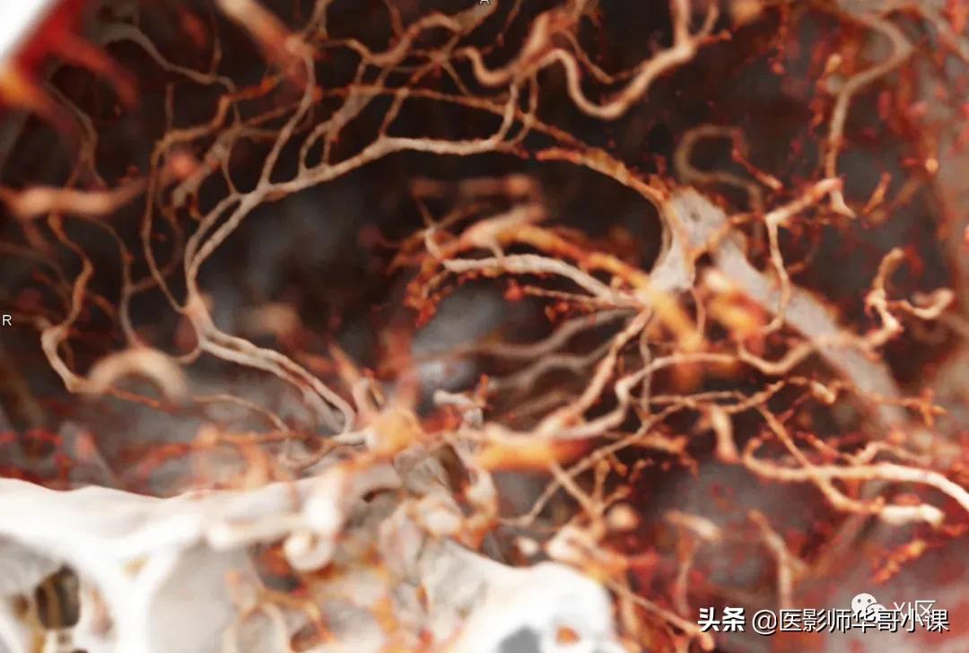 做完碘131检查后注意事项,碘造影剂的作用及使用