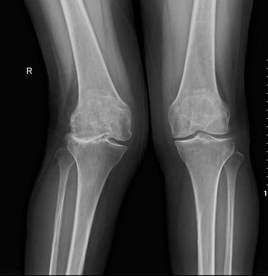 哪个医院治疗膝骨性关节炎最好,膝关节炎您想了解的小知识