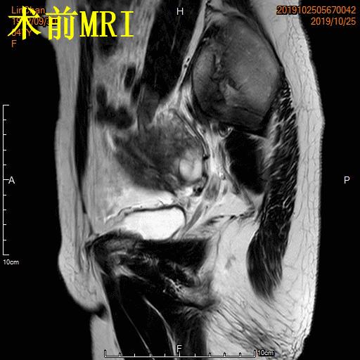 子宫腺肌症称为不死的癌症,子宫腺肌症是不死的癌症吗