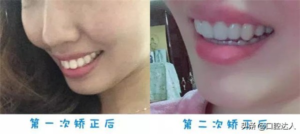 牙齿矫正的步骤,牙齿矫正怎么操作的