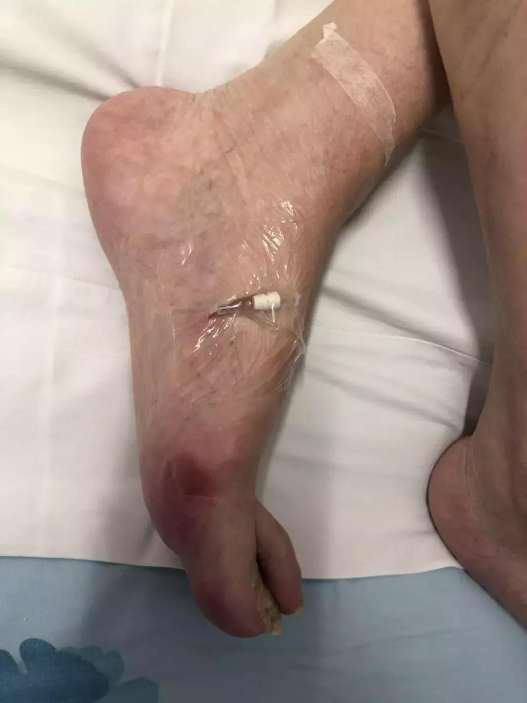 10岁儿童化疗,10个月宝宝恶性肿瘤能治好吗