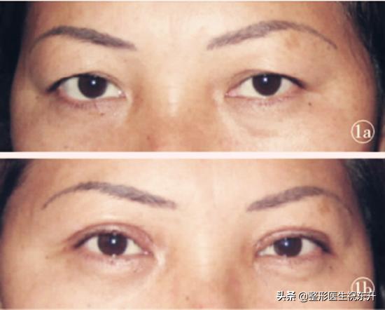 上睑松弛有什么解决办法,上睑皮肤松弛解决的方式有哪些
