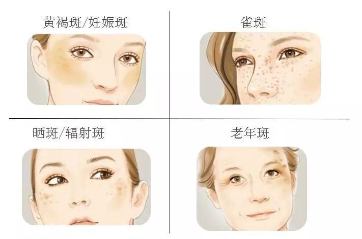 什么叫活性斑什么叫定性斑,为什么会长斑祛斑攻略了解一下