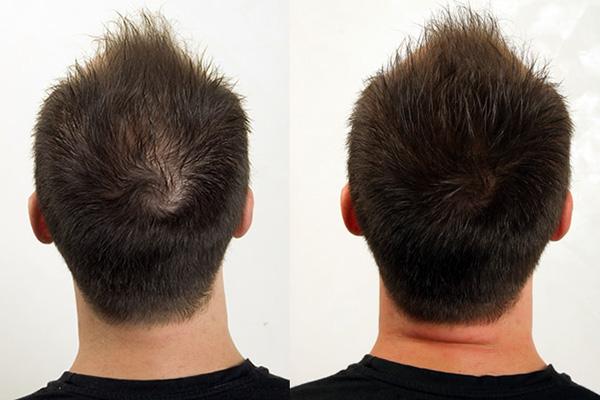 脱发毛囊没闭合怎么治疗,脱发毛囊闭合怎么办