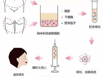 抽脂减肥和溶脂减肥的区别,溶脂与吸脂减肥的区别有哪些