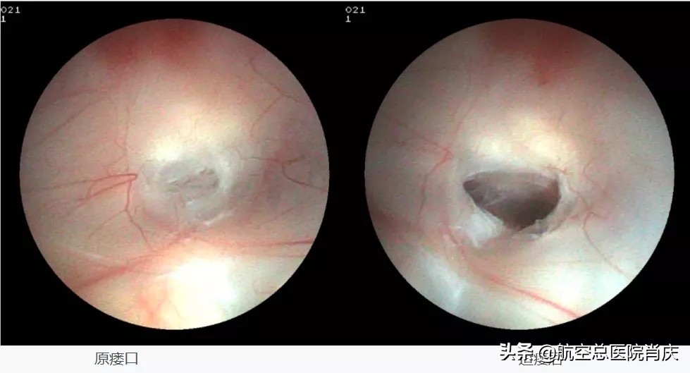 软性神经内镜，给花季少女一个终身不带管的机会
