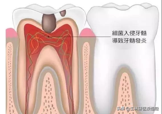 牙坏了医生说保不住为什么不给拔,牙崩了一半怎么补牙