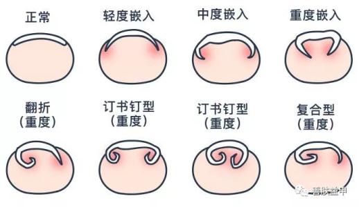 甲沟炎的症状及治疗方法,甲沟炎是什么症状怎样治疗