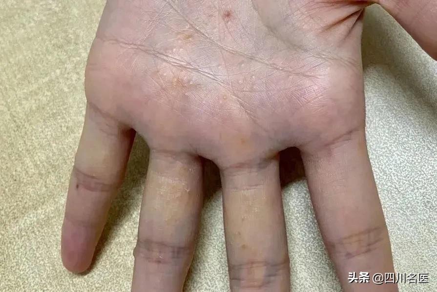 一到夏天手上起小水泡痒注意事项,手上长小水泡可能是什么原因引起