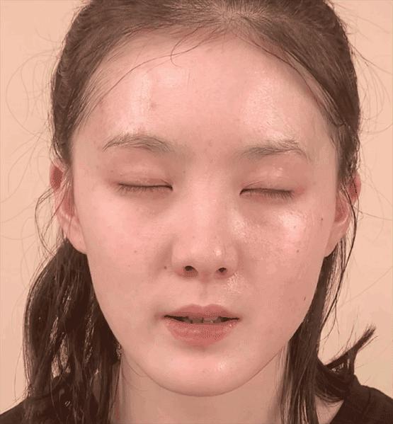 做了微整之后的感悟,微整经验