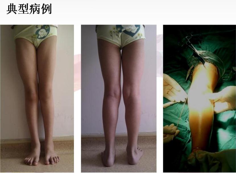 髌骨经常脱位?医生:这4种原因导致,有的人只要一蹲下就脱位