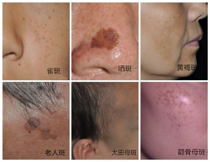 怎么改善肤色黄暗沉,怎么才能改善暗黄淡斑