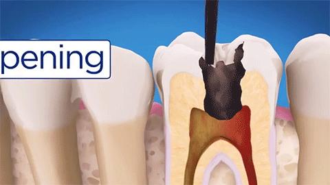 牙蛀了必须根管吗,牙蛀到什么程度需要补牙