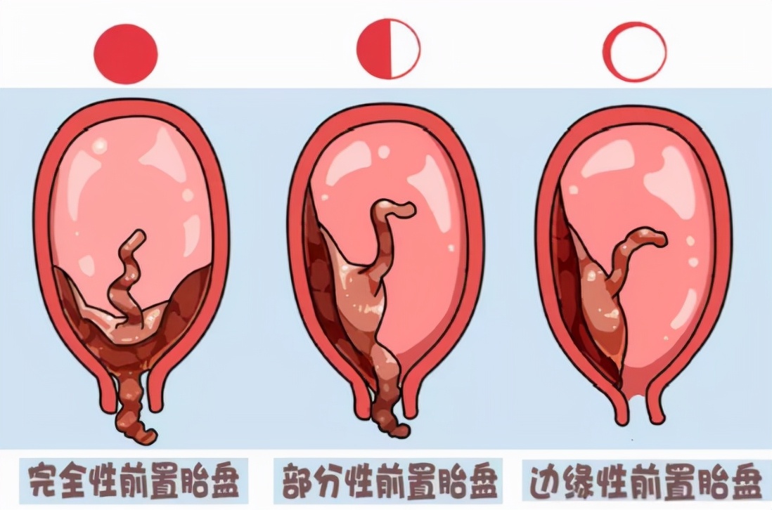 胎盘前置凶险,22周凶险性前置胎盘保胎成功案例
