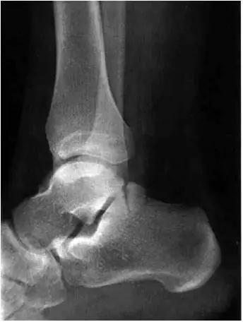 踝关节撞击症问诊,踝关节撞击综合征的x线表现