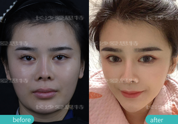 雀斑适合光子嫩肤还是皮秒,祛雀斑用超皮秒好还是光子嫩肤好