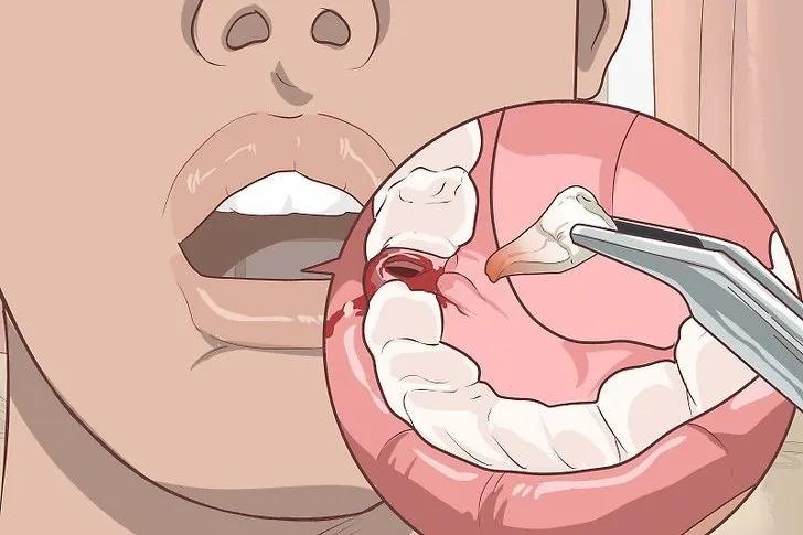 拔牙干槽症几天能治愈,干槽症不处理牙窝会愈合吗