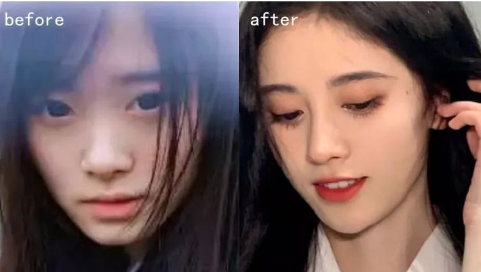 贵族手术的好处,鼻基底手术失败凹陷怎么改善