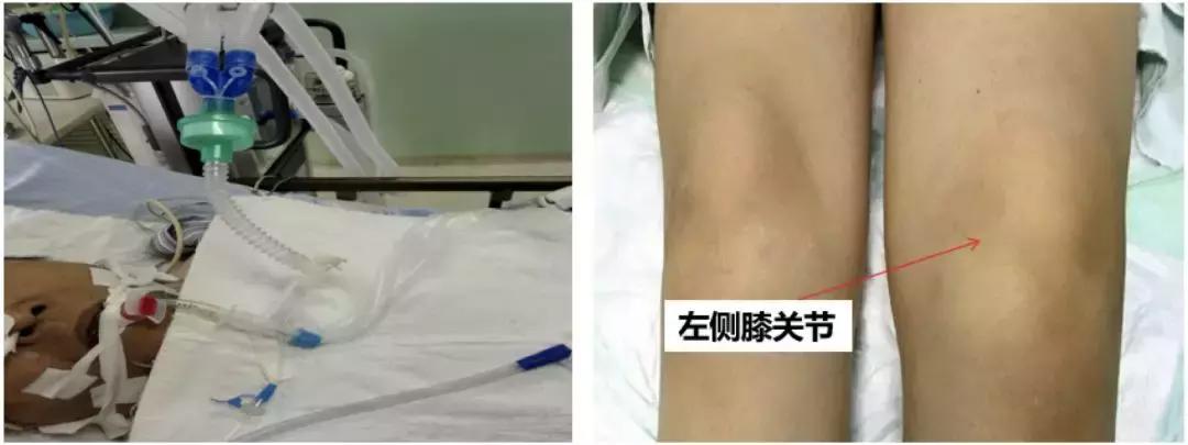 万古霉素用于mrsa的作用机制,万古霉素无效还有什么抗生素可用