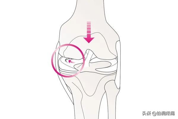 半月板虽然三度损伤但不影响走路,半月板损伤好了膝盖还是有点不直