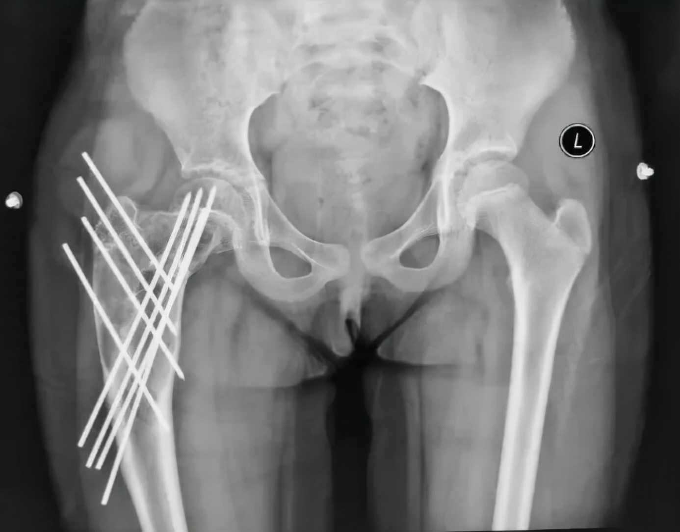 骨与软组织肿瘤治疗指南,骨与软组织肿瘤诊疗指南