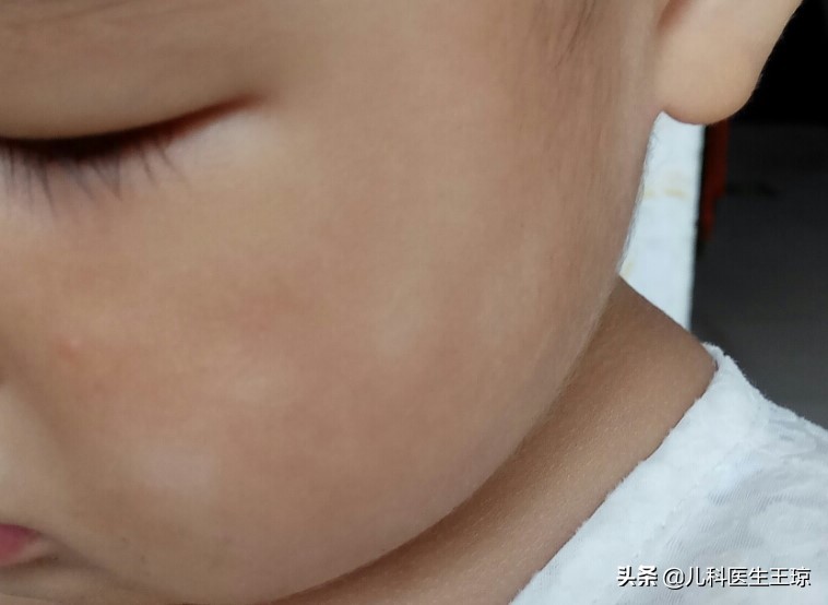 孩子脸上虫斑什么样,孩子脸上的虫斑到底是什么