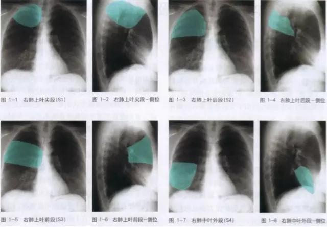 详细的胸部X线解剖，最基础最实用！