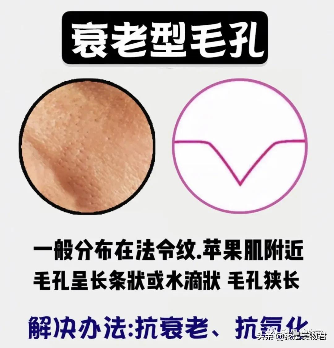 胸口毛孔粗大是什么原因,皮肤粗糙暗沉毛孔粗大什么原因