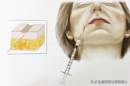 面部除皱用什么方法效果最好,目前面部除皱最安全有效的方法
